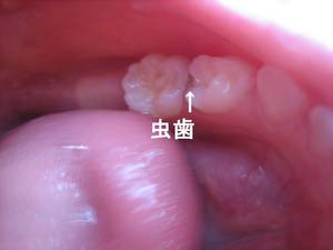 虫歯