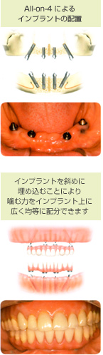 オールオンフォー