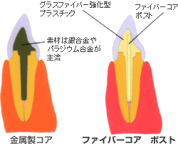 ファイバーコア　ポスト