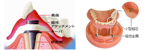 磁性アタッチメント